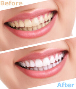 teeth whitening before after