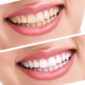 teeth whitening before after