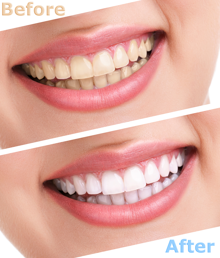 teeth whitening before after